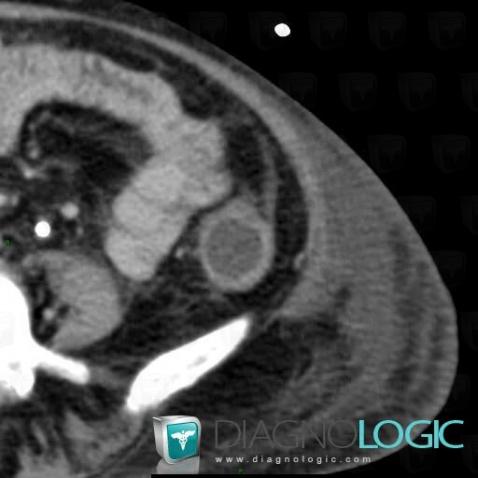 Cas radiologie : Colite pseudomembraneuse (Scanner) - Diagnologic