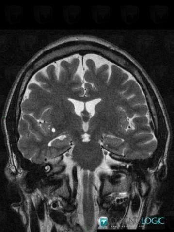 Colloid cyst, Cerebral falx / Midline, MRI