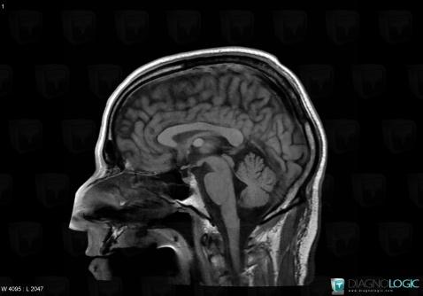 Colloid cyst, Cerebral falx / Midline, MRI
