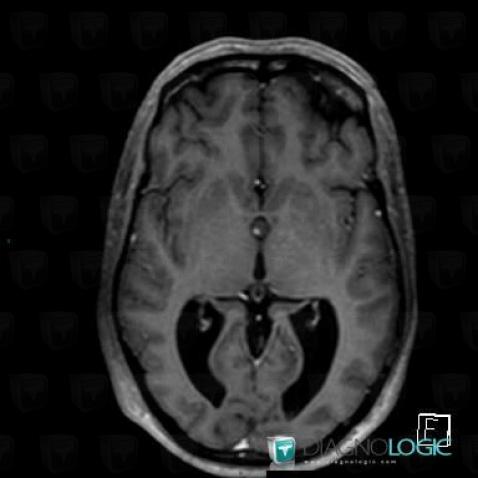Colloid cyst, Cerebral hemispheres, MRI