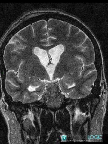 Colloid cyst, Cerebral hemispheres, MRI