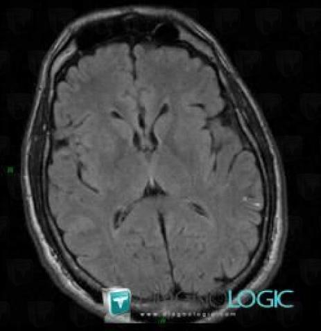 Colloid cyst, Cerebral hemispheres, MRI