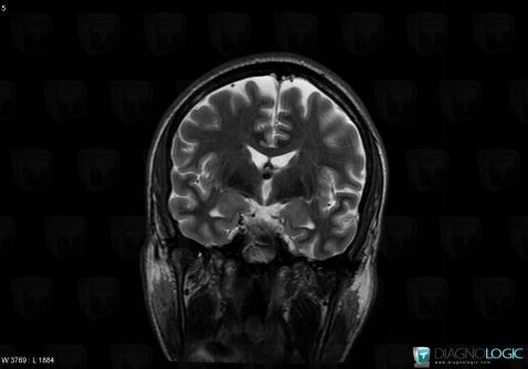 Colloid cyst, Cerebral hemispheres, MRI