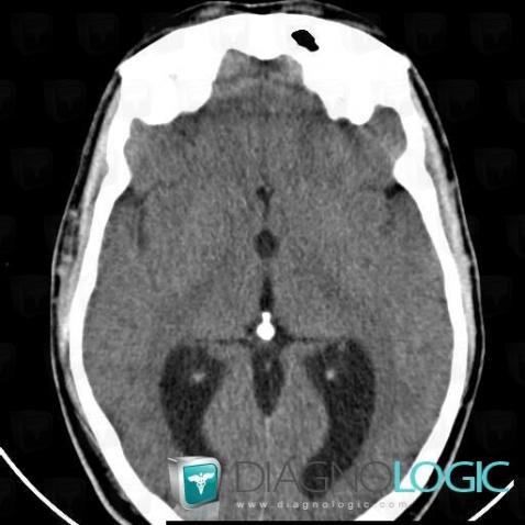 Colloid cyst, Cerebral hemispheres, Ventricles / Periventricular region, CT