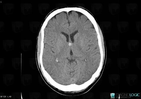 Colloid cyst, Cerebral hemispheres, Ventricles / Periventricular region, CT