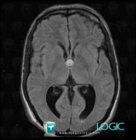 Colloid cyst, Cerebral hemispheres, Ventricles / Periventricular region, MRI
