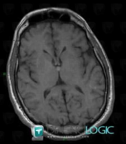 Colloid cyst, Cerebral hemispheres, Ventricles / Periventricular region, MRI