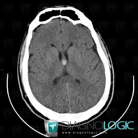 Colloid cyst, Ventricles / Periventricular region, CT