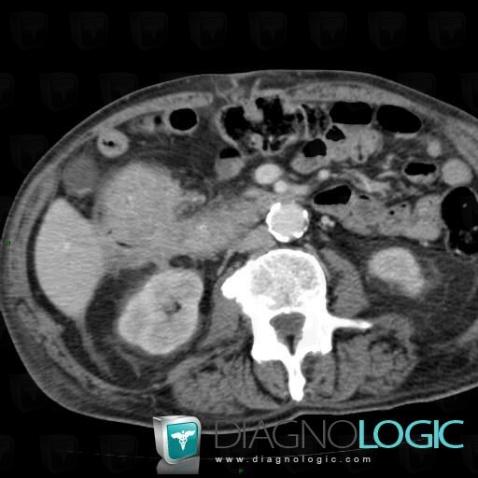 Colon cancer, Colon, CT