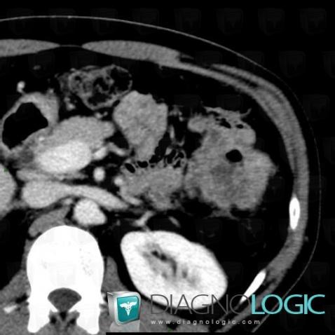 Colon cancer, Colon, CT