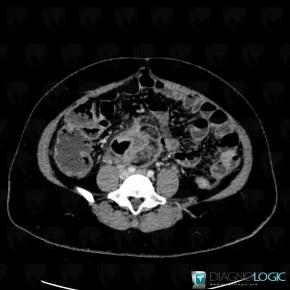 Colon cancer, Colon, CT