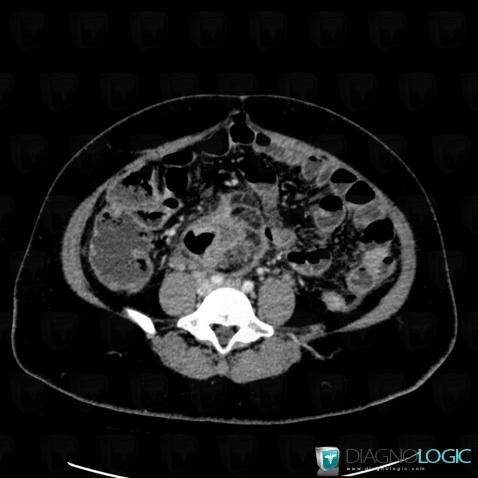 Colon cancer, Colon, CT