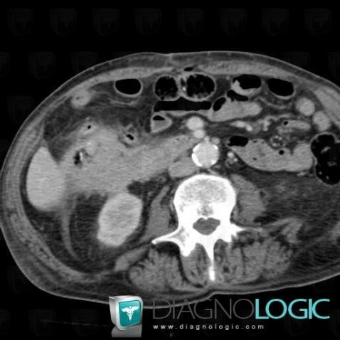 Colon cancer, Duodenum, CT