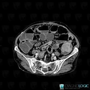 Colon cancer, Small bowel, Colon, CT