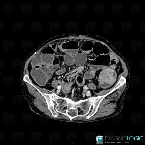 Colon cancer, Small bowel, Colon, CT