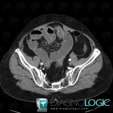 Colon cancer, Small bowel, CT