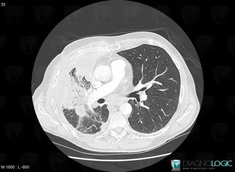 Common infectious pneumonia, Pulmonary parenchyma, CT