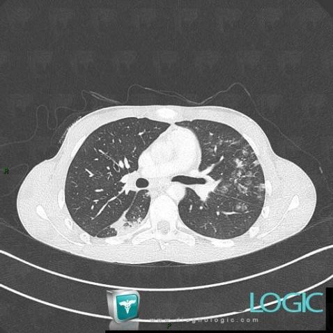 Common infectious pneumonia, Pulmonary parenchyma, CT