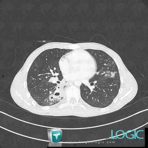 Common infectious pneumonia, Pulmonary parenchyma, CT