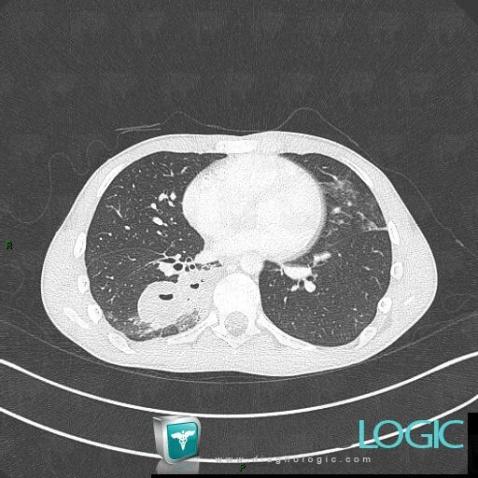 Common infectious pneumonia, Pulmonary parenchyma, CT