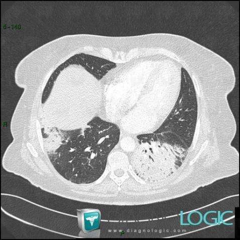 Common infectious pneumonia, Pulmonary parenchyma, CT