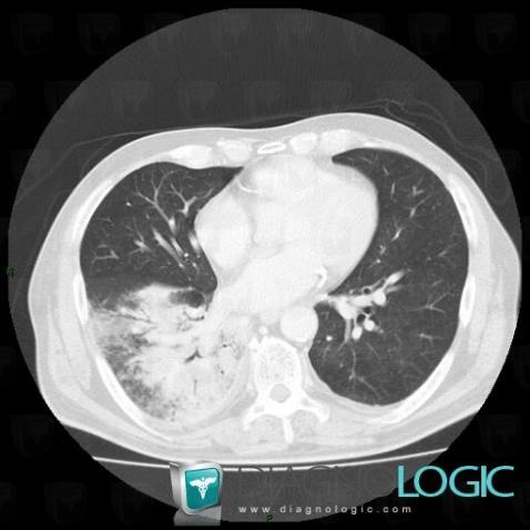 Common infectious pneumonia, Pulmonary parenchyma, CT