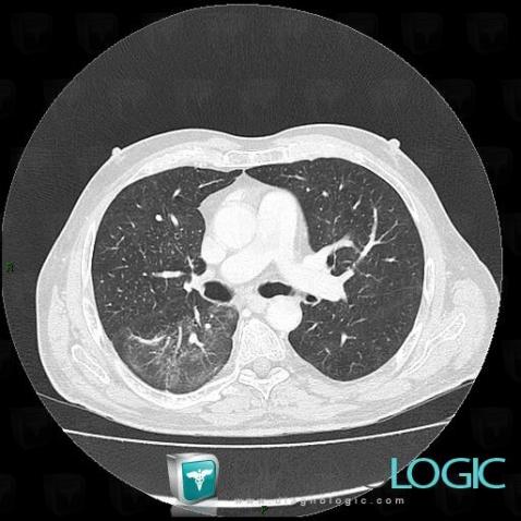 Common infectious pneumonia, Pulmonary parenchyma, CT