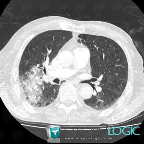 Common infectious pneumonia, Pulmonary parenchyma, CT