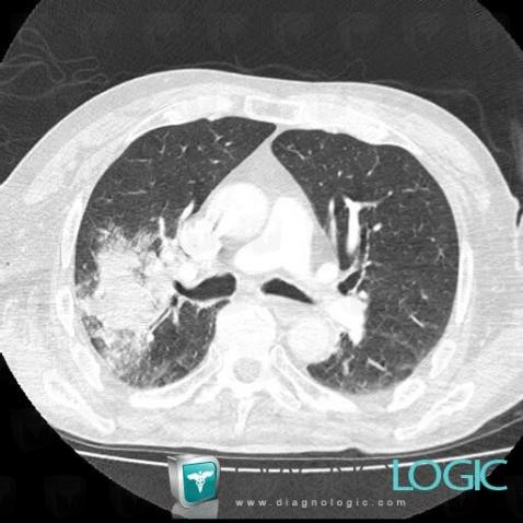 Common infectious pneumonia, Pulmonary parenchyma, CT