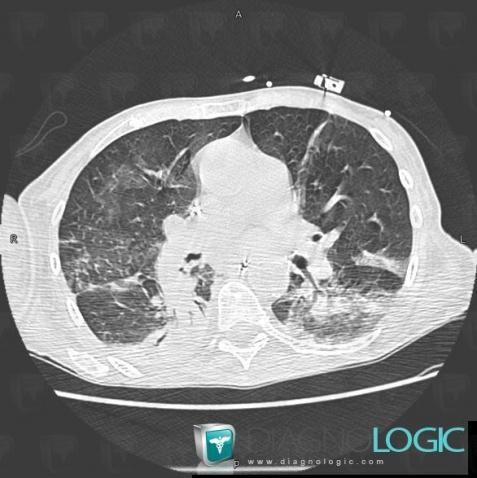 Common infectious pneumonia, Pulmonary parenchyma, CT