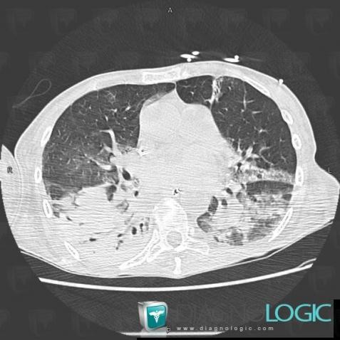 Common infectious pneumonia, Pulmonary parenchyma, CT