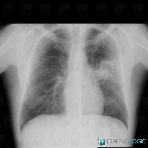 Common infectious pneumonia, Pulmonary parenchyma, X rays