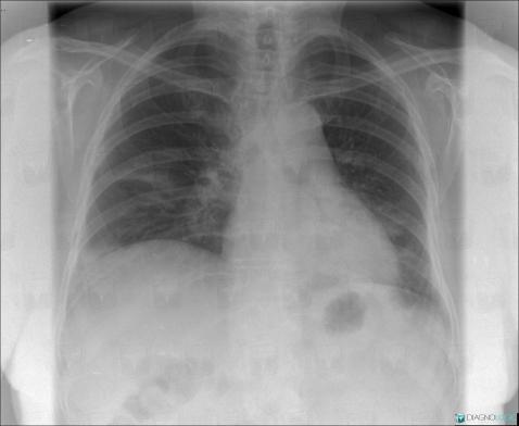 Common infectious pneumonia, Pulmonary parenchyma, X rays