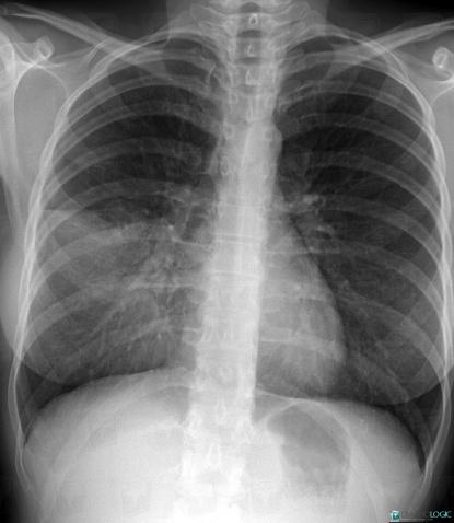 Radiology case : Common infectious pneumonia (X rays) - Diagnologic