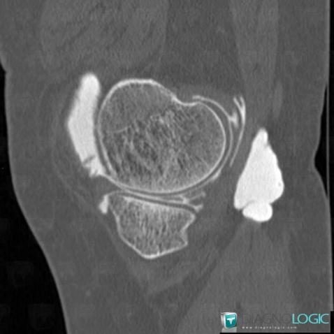 Complex meniscal tear, Meniscus, CT