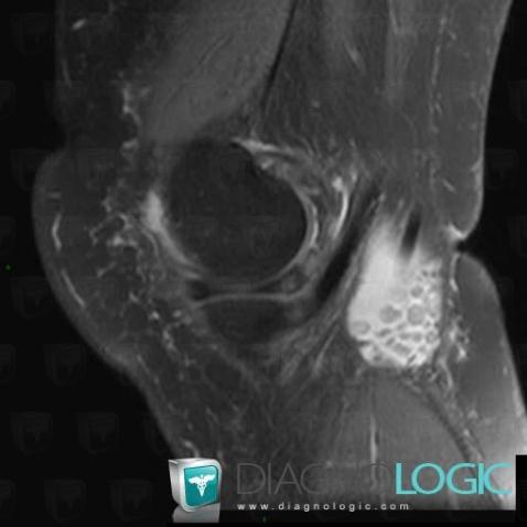 Complex meniscal tear, Meniscus, MRI