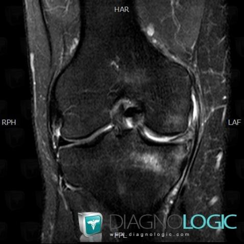 Complex meniscal tear, Meniscus, MRI