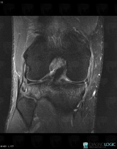 Complex meniscal tear, Meniscus, MRI