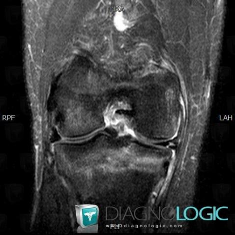 Complex meniscal tear, Meniscus, MRI