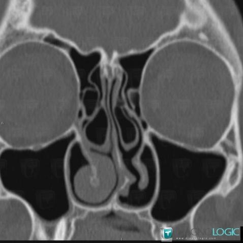 Concha bullosa, Nasal cavity / Nasopharynx, CT