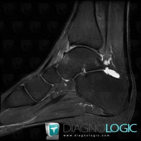 Cas radiologie L sion ost ochondrale IRM Diagnologic