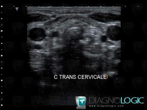 Congenital athyreosis, Thyroid / Parathyroid, US