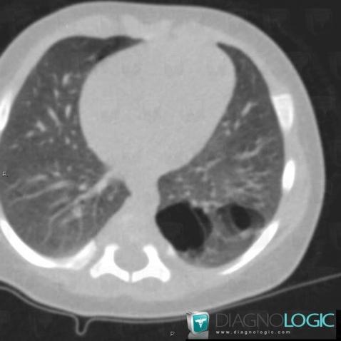 Congenital cystic adenomatoid malformation, Pulmonary parenchyma, CT