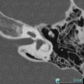 Congenital facial nerve agenesis, VII VIII nerves, CT