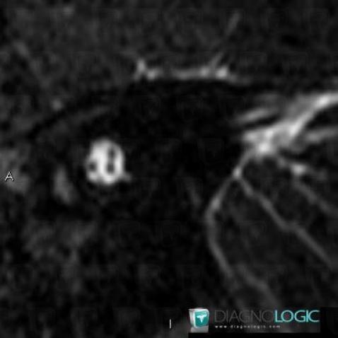 Congenital facial nerve agenesis, VII VIII nerves, MRI