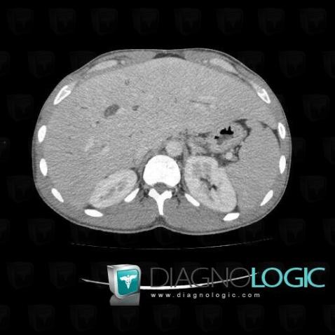 Congenital hepatic fibrosis with tubular ectasia, Liver, CT