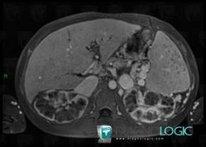 Congenital hepatic fibrosis with tubular ectasia, Liver, MRI