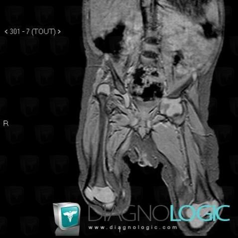 Congenital hip dislocation, Coxo femoral joint, MRI