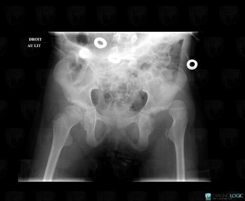 Congenital hip dislocation, Coxo femoral joint, X rays