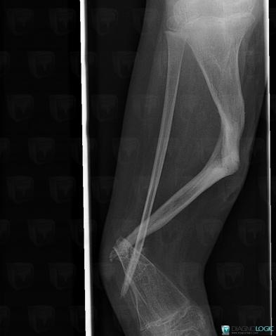 Congenital pseudarthrosis, Tibia - Mid part, X rays